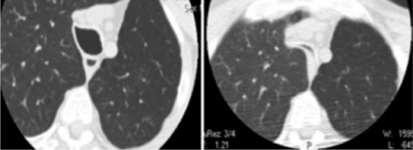 tracheobronchomalacia (TBM)