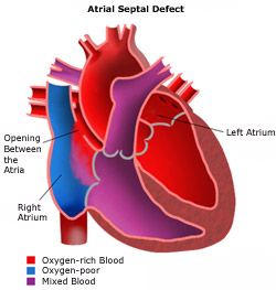 Atrial Septal Defect