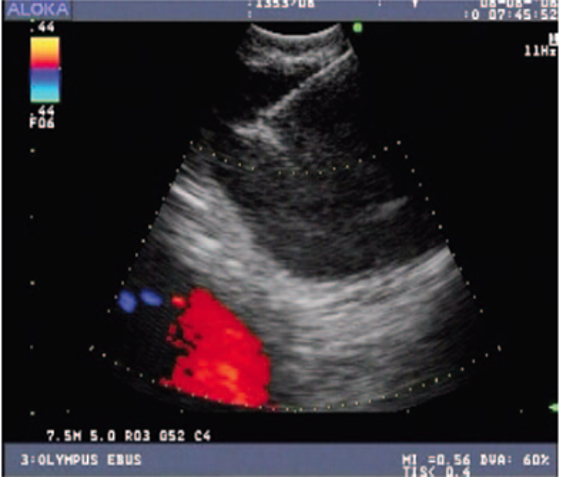 bronchoscopy with endobronchial ultrasound