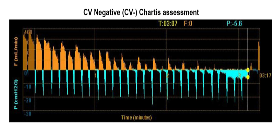 CV Negative Chartis Assessment