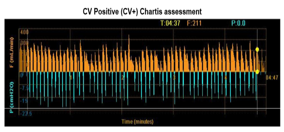 CV Positvie Chartis Assessment