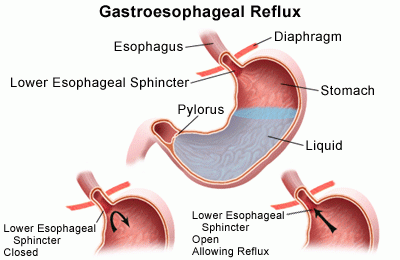 Diagram of gastroesophageal reflux.