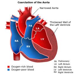  Coarctation of the Aorta
