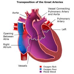 Transposition of the great arteries