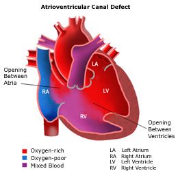 Atrioventricular Canal