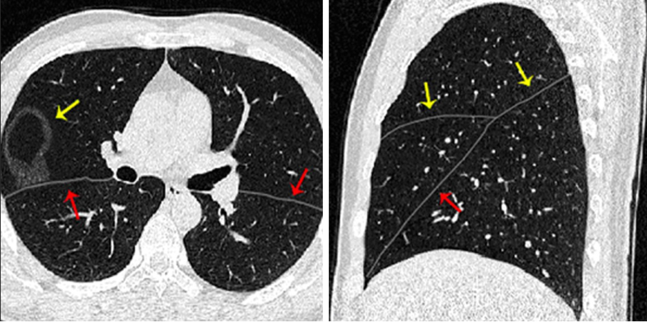 lung images